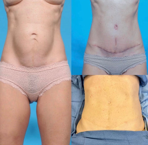 Before, after, and 2 years after tummy tuck with respect to incision at bikini area