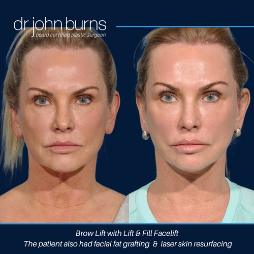 Before and after Brow lift, Facelift, neck lift, facial fat grafting and CO2 by Dr. John Burns