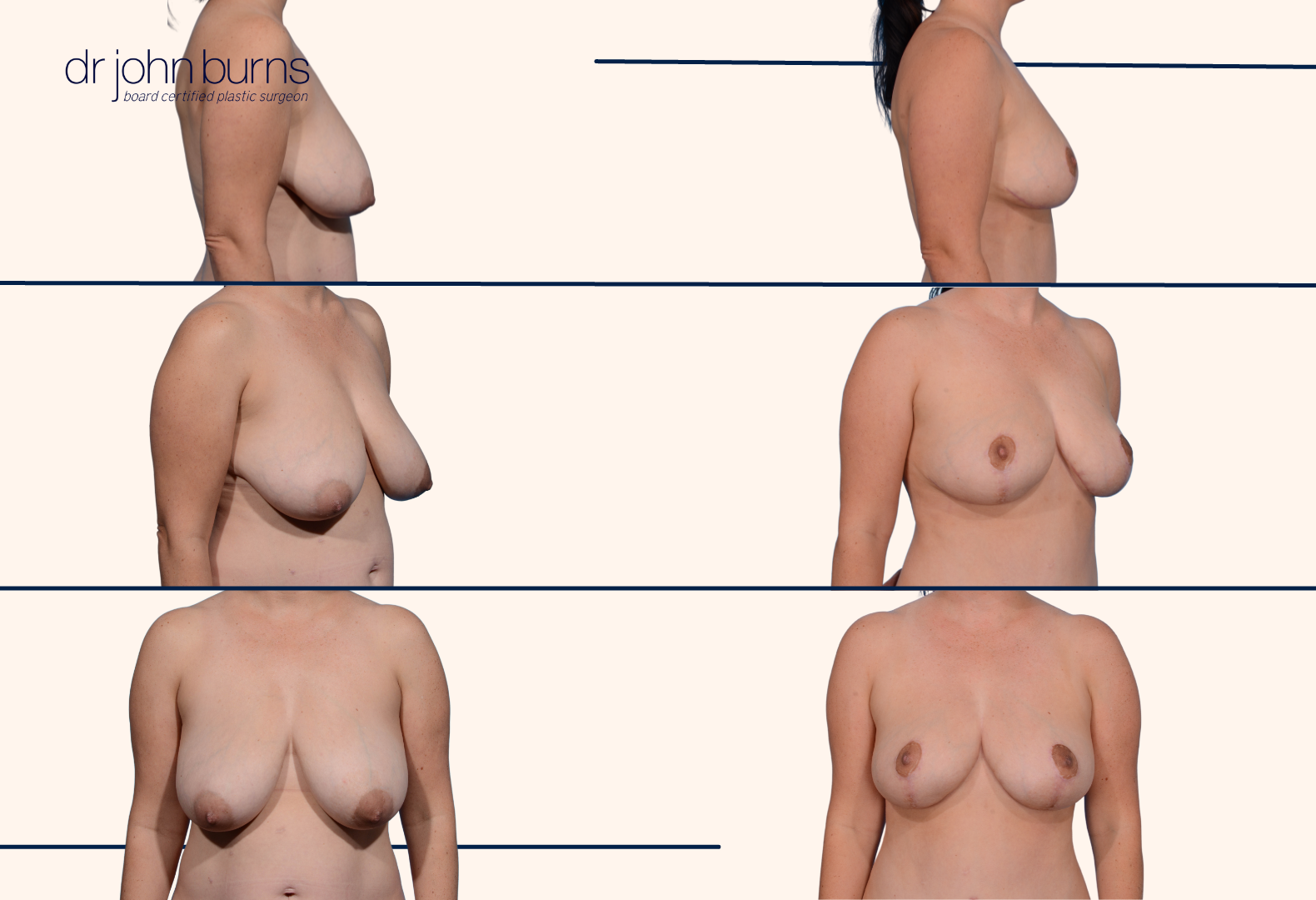 Breast reduction before and after by Dr. John Burns