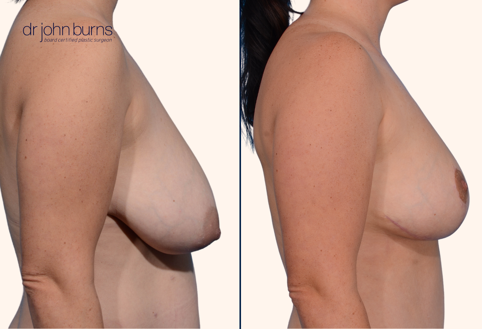 Breast reduction before and after by Dr. John Burns