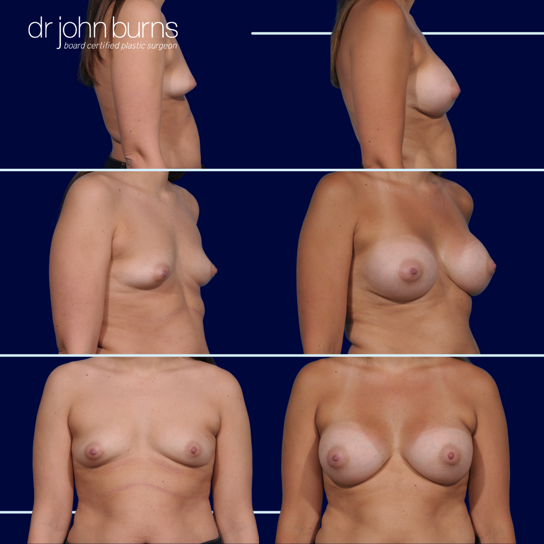 Breast Augmentation to Correct Tuberous Breast Deformity by Dr. John Burns MD