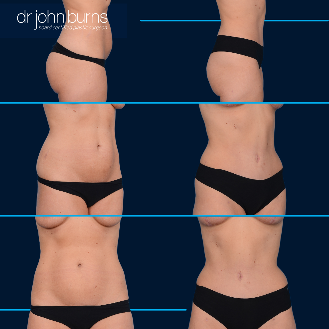 Before and After Tummy Tuck in Dallas by Dr. John Burns