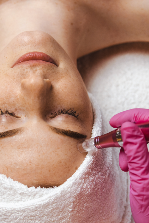 Woman Getting Microneedling Done on Forehead