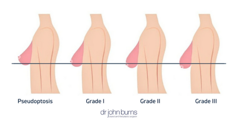 Breast Ptosis Classifications, Grade 1-3 by Dr. John Burns MD in Dallas, Texas