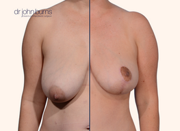 before and after breast lift with breast lift scars