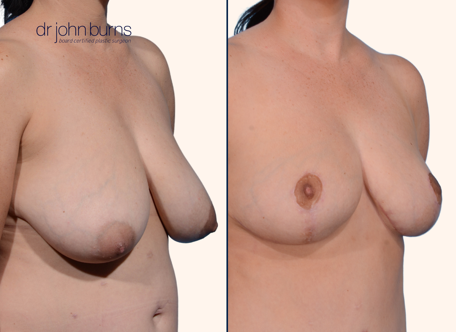 before and after breast lift with breast lift scars