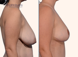 before and after breast lift with breast lift scars