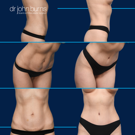 Before and After Liposuction in Dallas, Texas