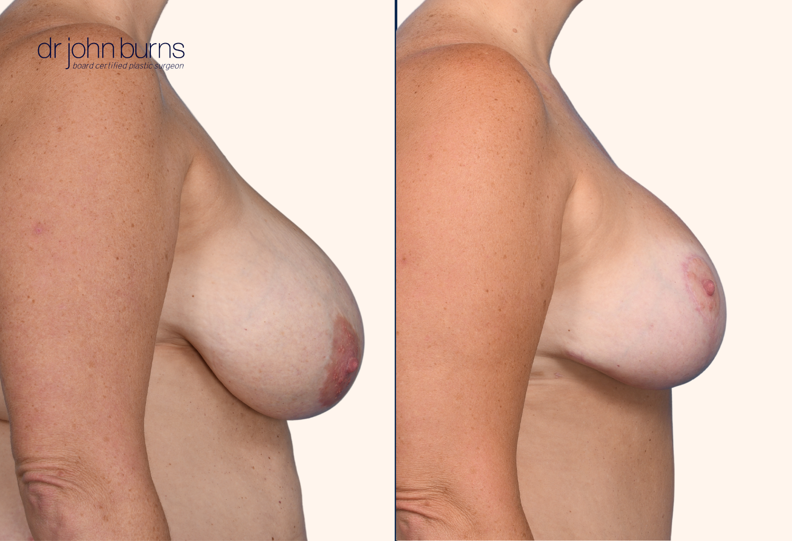 Breast reduction before and after by Dr. John Burns