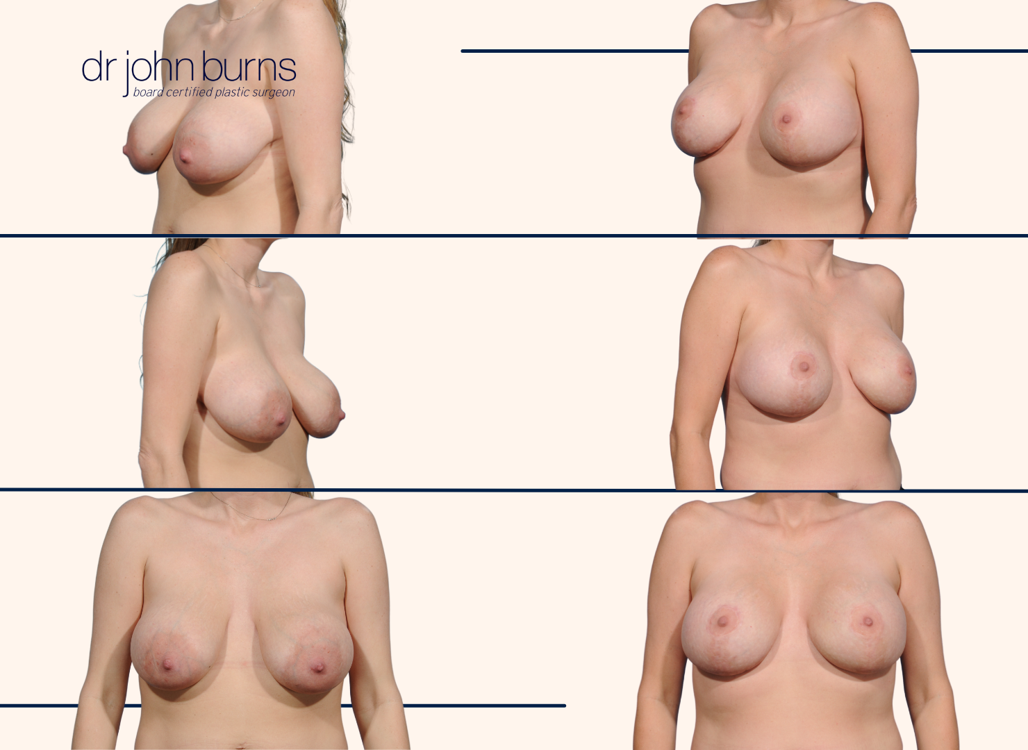 Before and after breast lift with scars 