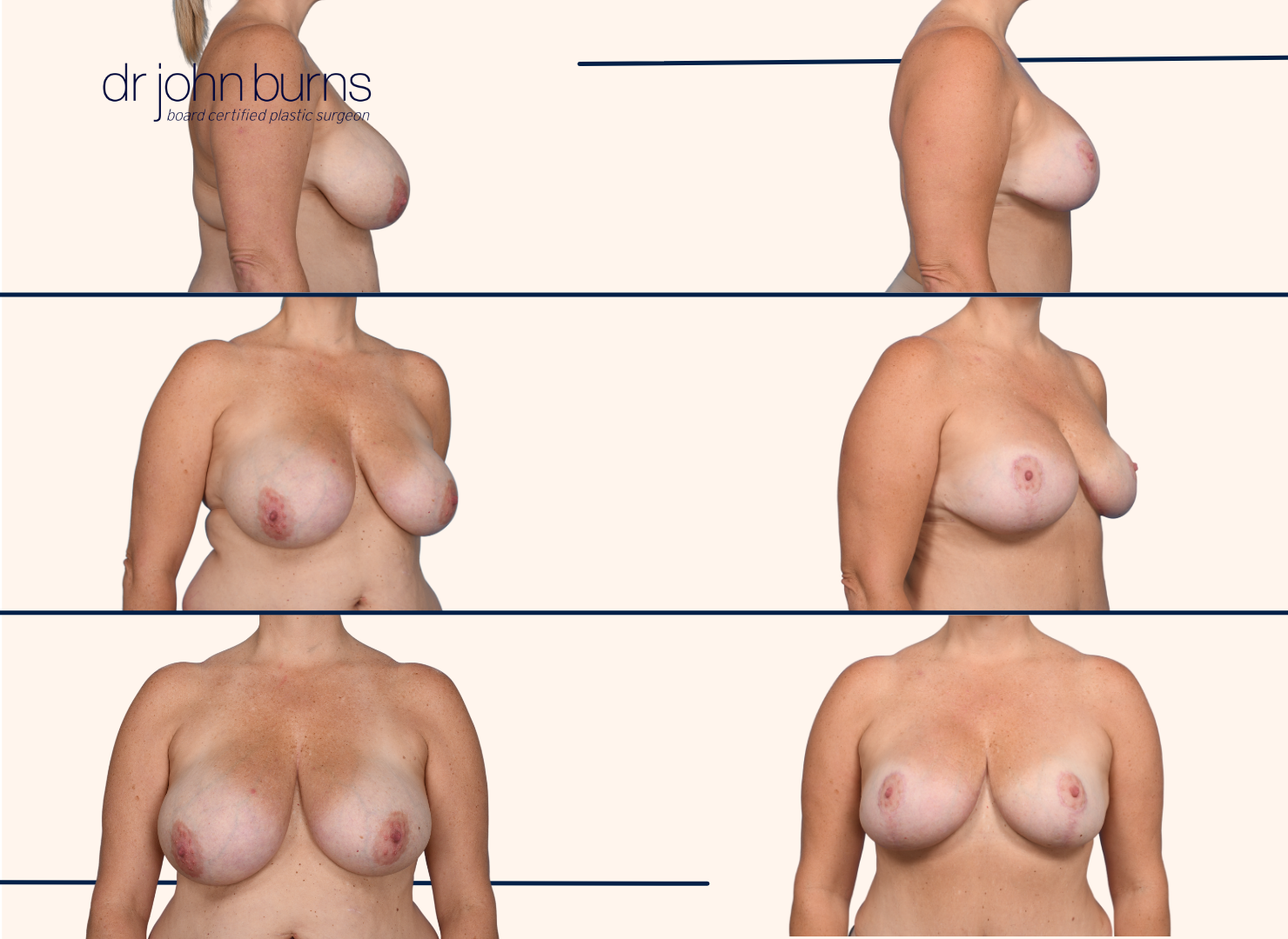 before and after breast lift with breast lift scars