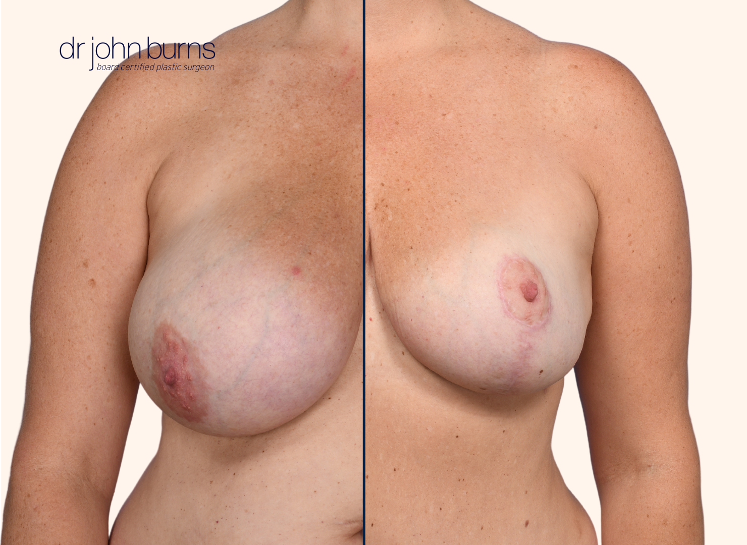 before and after breast lift with breast lift scars