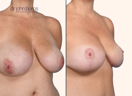 before and after breast lift with breast lift scars