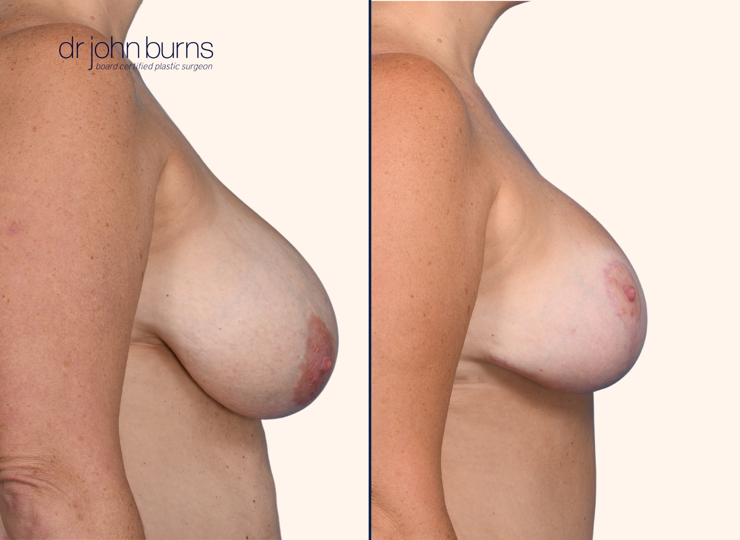 before and after breast lift with breast lift scars