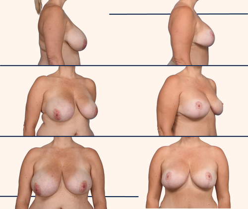 Before and after breast reduction by Dallas