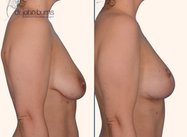 before and after breast lift with breast lift scars 