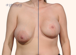 Before and after breast lift with scars 