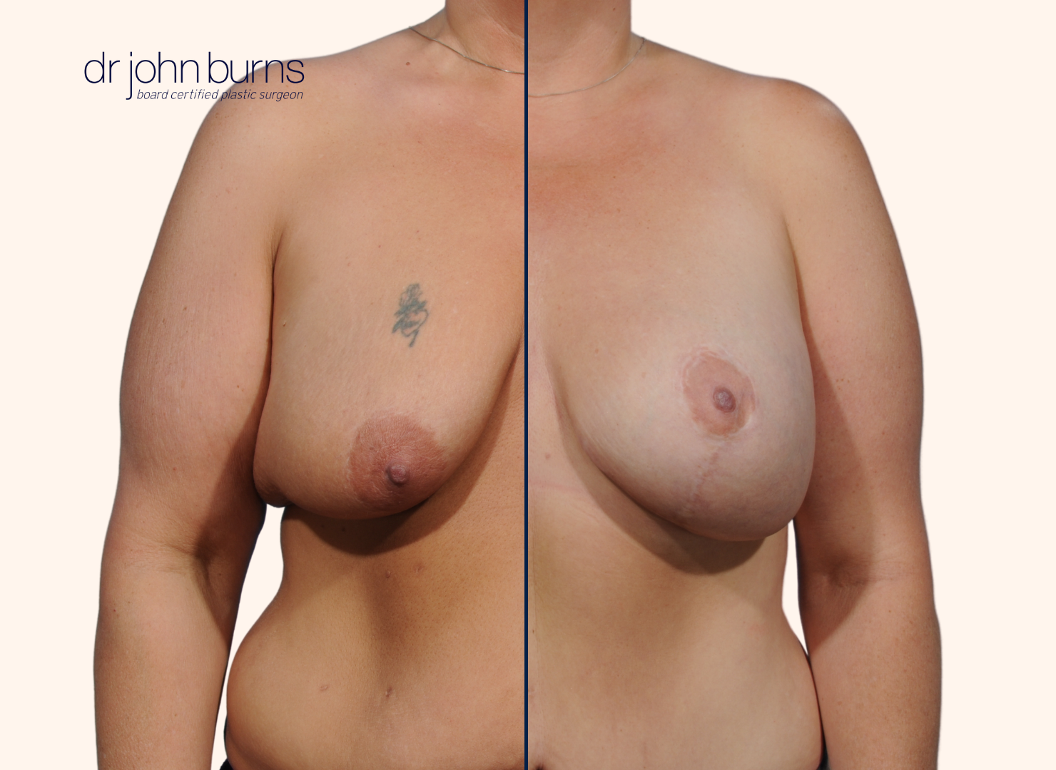 before and after breast lift with breast lift scars