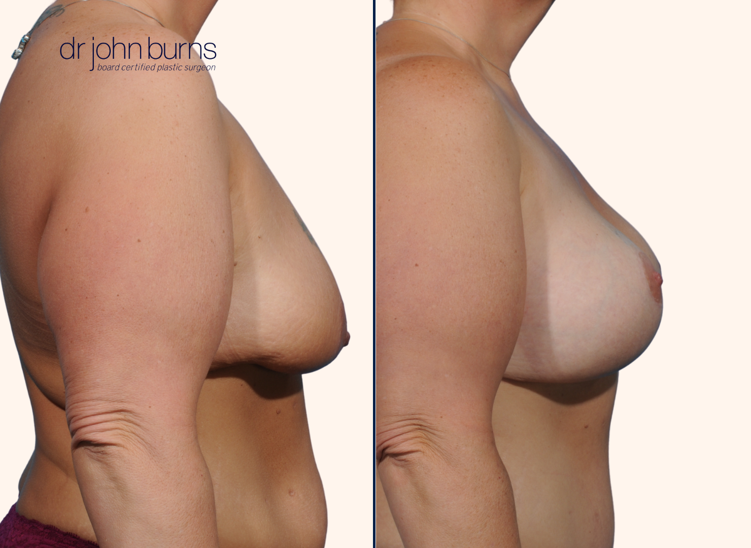 before and after breast lift with breast lift scars