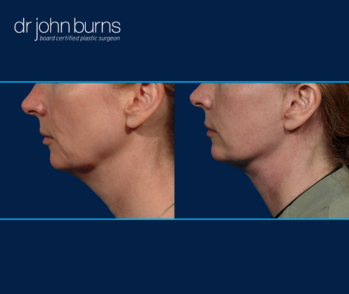 Left profile view | before and after neck lift in Dallas by Dr. John Burns
