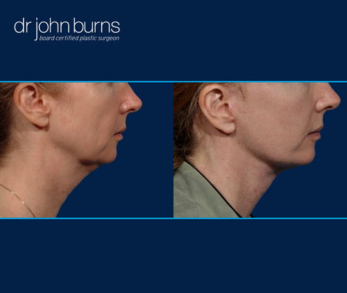 Right profile view | before and after neck lift in Dallas by Dr. John Burns