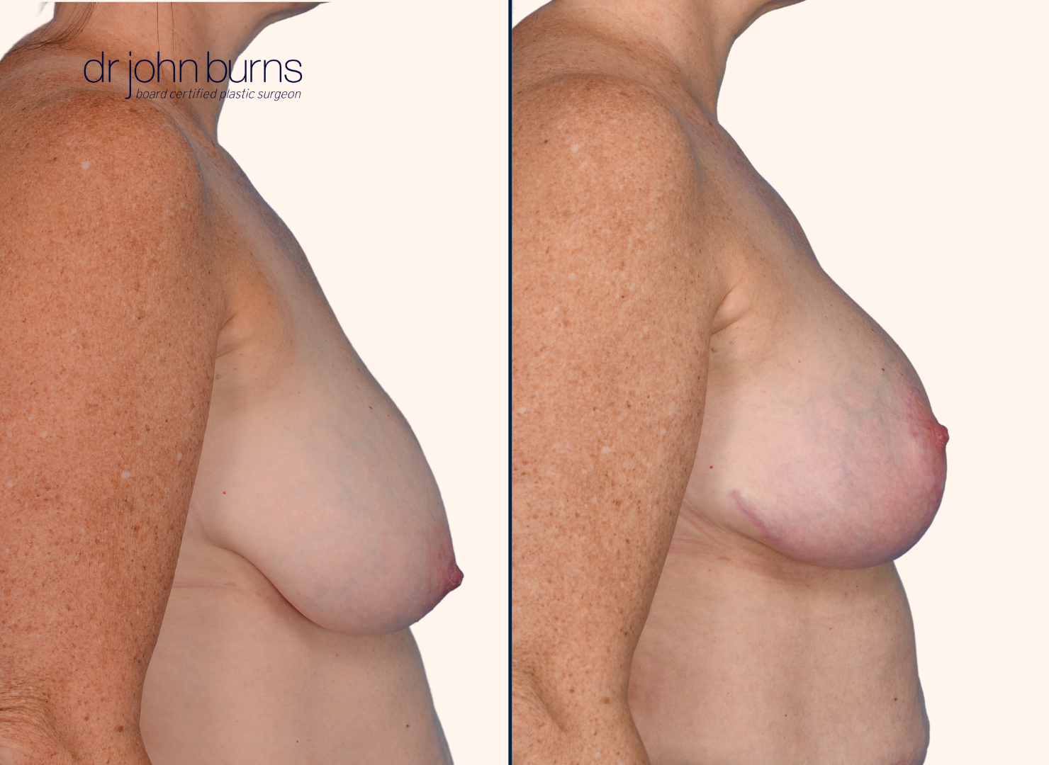 before and after breast lift with scars