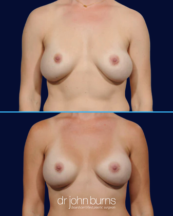 Before and after lateral displacement, bottomed out breast implants by Dallas plastic surgeon, Dr. John Burns