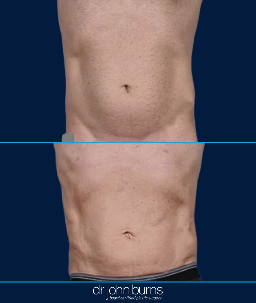 Lipo Before and After by Dr. John Burns MD.png__PID:3b055838-b3b1-4af9-b609-21882d2add62