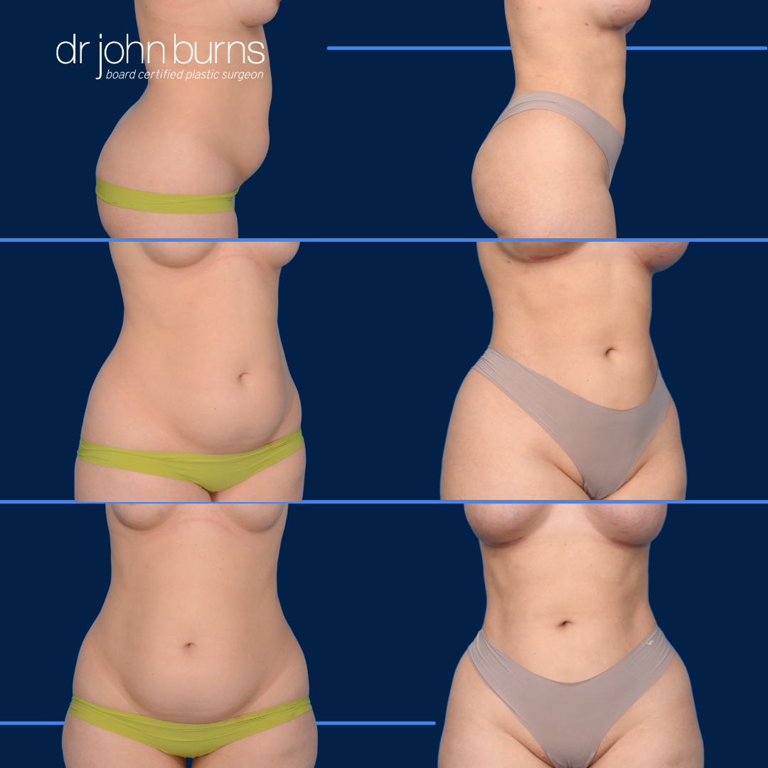 Lipo before and after- Dr. John Burns- America's Best Plastic Surgeons.png__PID:dd1c6246-5269-428f-b32f-f768b593c5b2