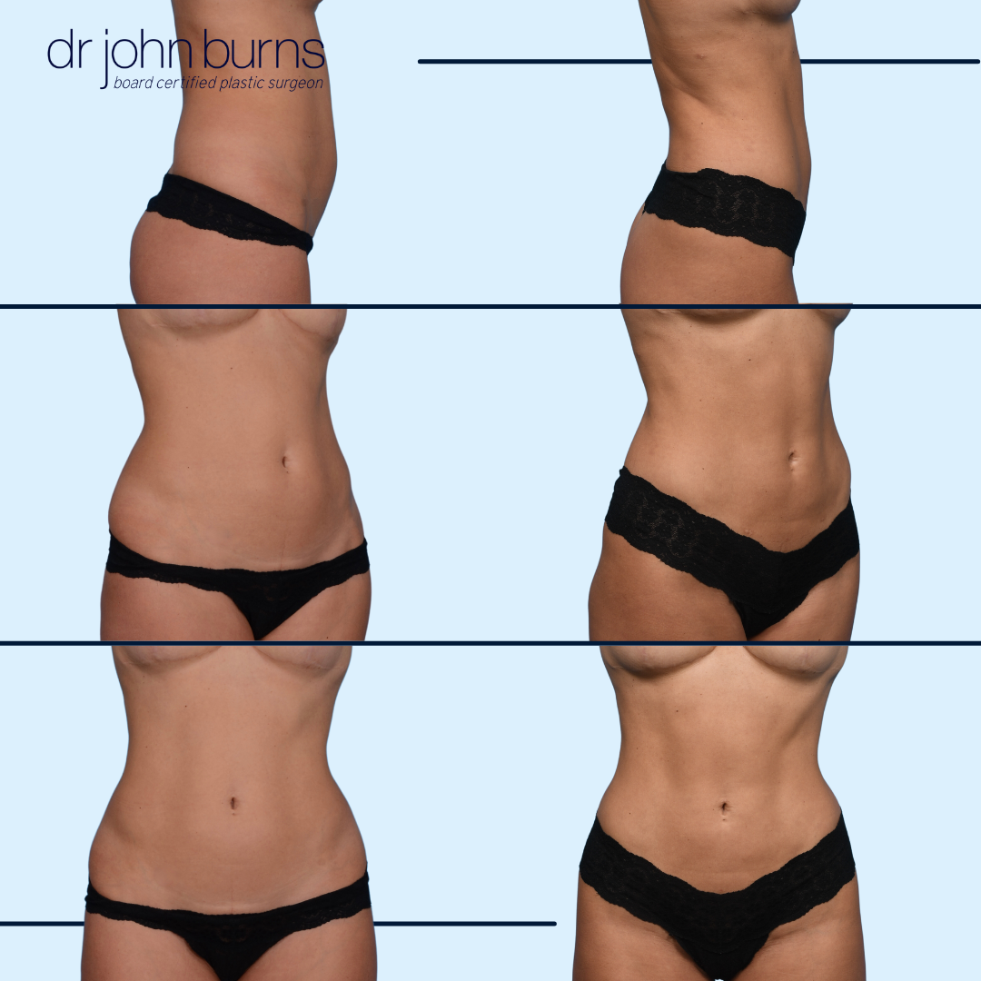 Lipo before and after-Dallas Texas- Dr. John Burns