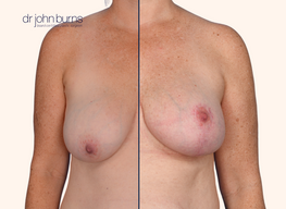 Before and after breast lift with scars 
