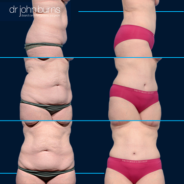 Before and after corset tummy tuck by Dr. John Burns