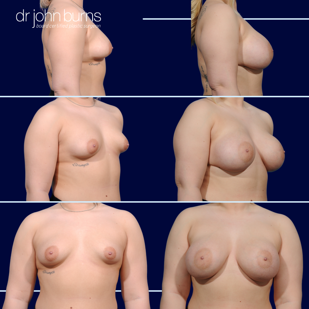 Breast Augmentation to Correct Tuberous Breast Deformity by Dr. John Burns MD