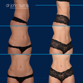 Before and After Liposuction in Dallas, Texas