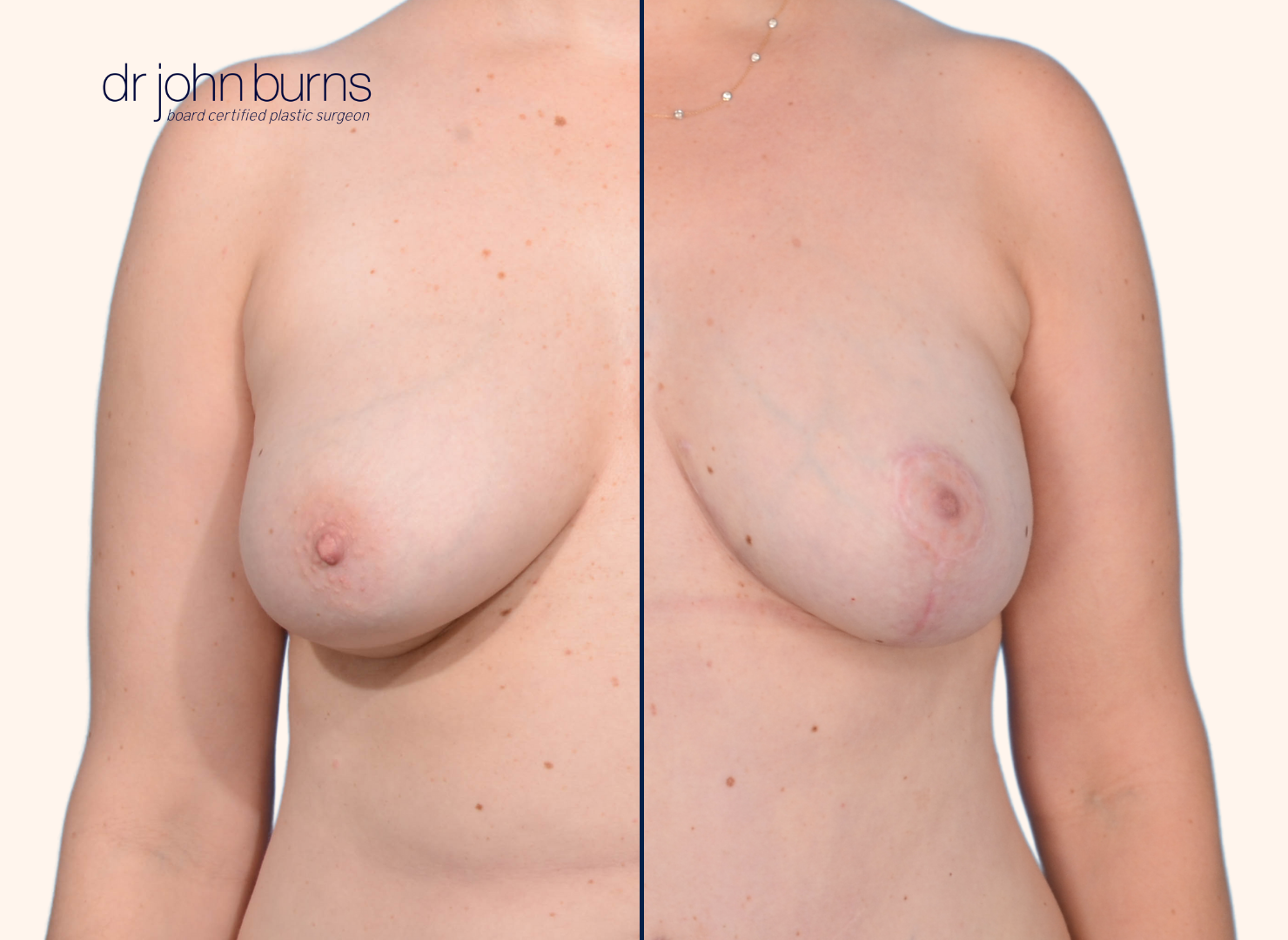 Before and after breast lift with scars