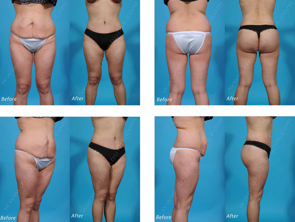 tummy tuck undergarment