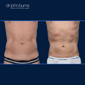 Before and After Liposuction in Dallas, Texas