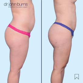 Before and After Liposuction in Dallas, Texas