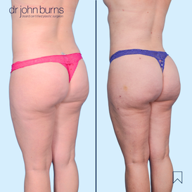 Before and After Liposuction in Dallas, Texas