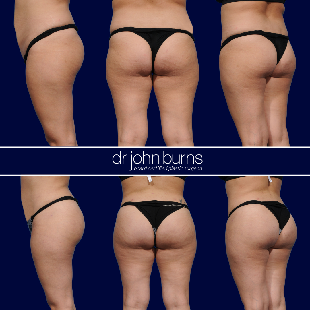 Before and after tummy tuck, bbl,and lipo 360- Dr. John Burns MD- Dallas, Texas
