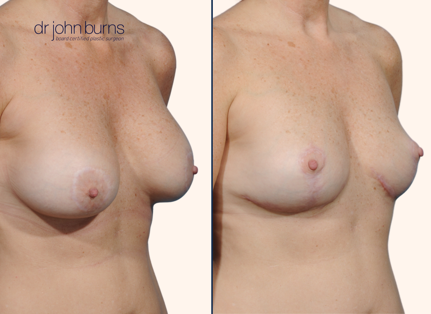 Before and after breast lift with scars