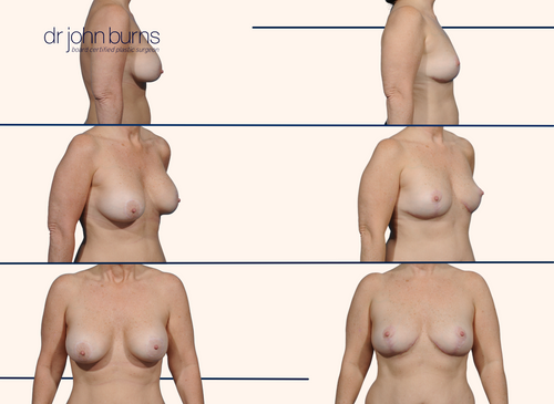 Before and after breast lift with scars