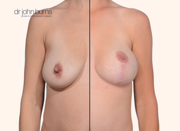 Before and after breast lift with scars