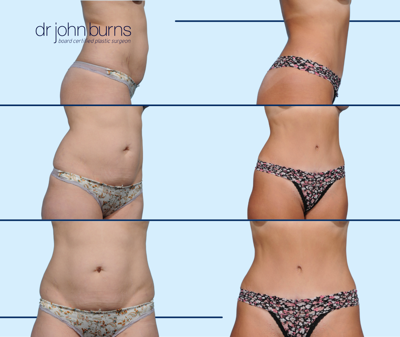 Before and after tummy tuck by Dallas Tummy tuck expert, Dr. John Burns