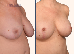Before and after breast lift with implants