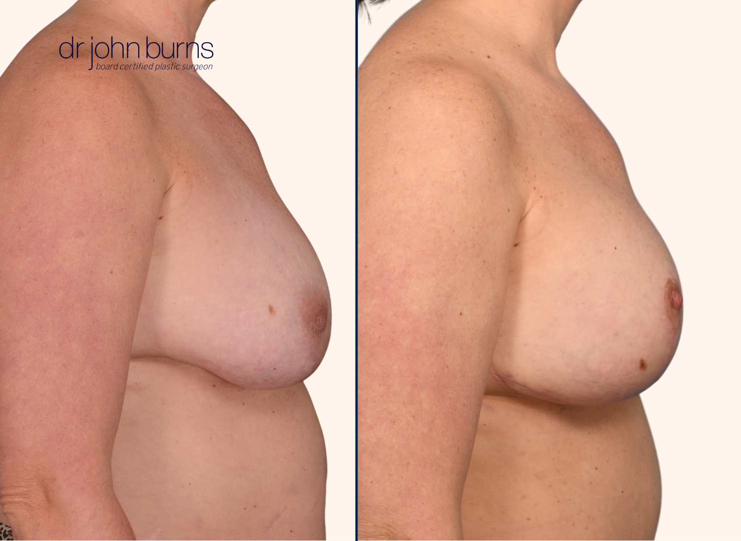 Before and after breast lift with implants