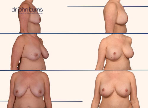 Before and after breast lift with implant