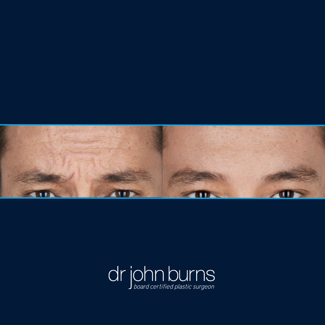 Male Botox before and after, Dallas, TX | Dr. John Burns