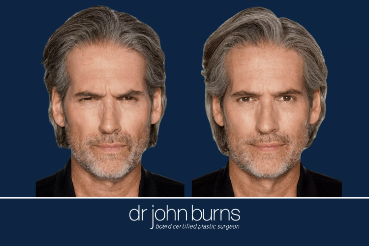 Male Daxxify Before and After.png__PID:e7271e2b-1116-4c9c-abb7-a48b6c7c2377
