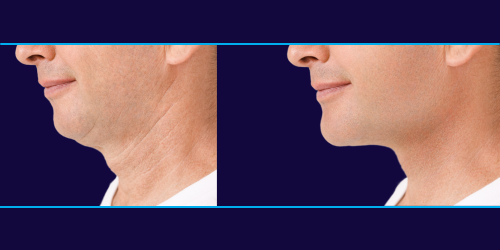 Male chin augmentation in Dallas, TX, Dr. John Burns.png__PID:0ff74ff3-accc-48ab-8ecf-66dd4bf9c377